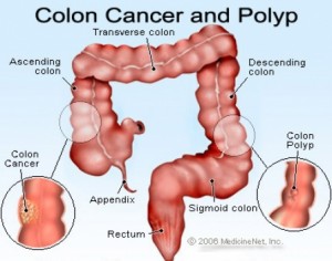 colon caner and polyp